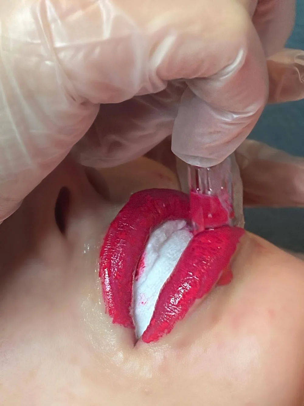 BB Lips – during treatment