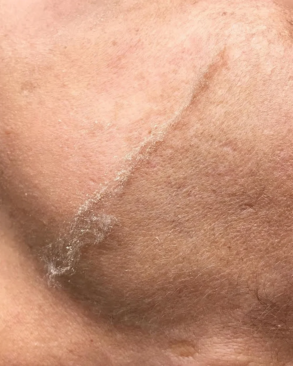 Baby Soft Skin – during treatment