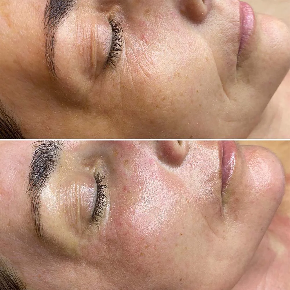 Mezo Glow – during treatment