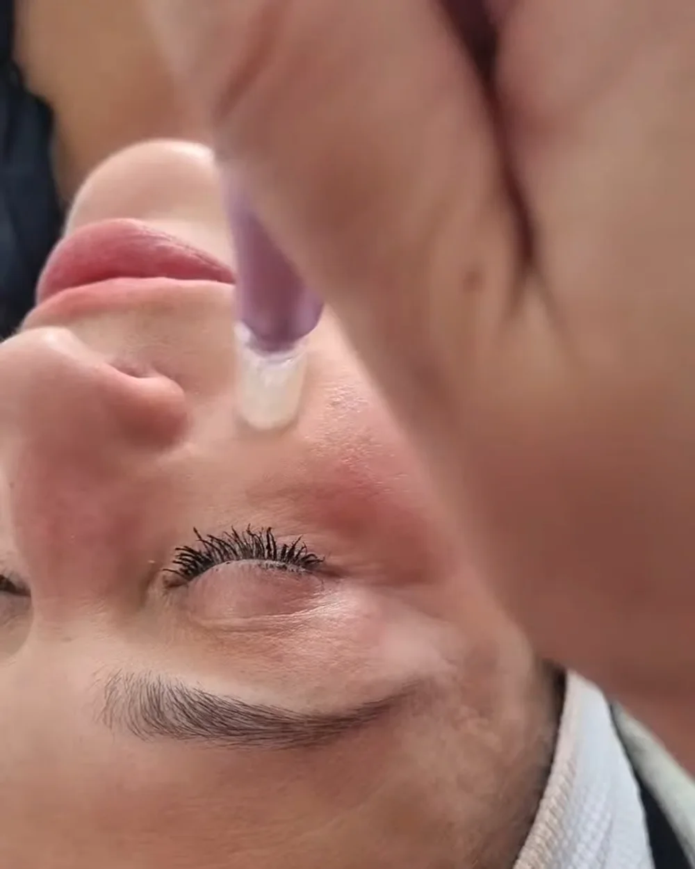 Mezo Glow – during treatment
