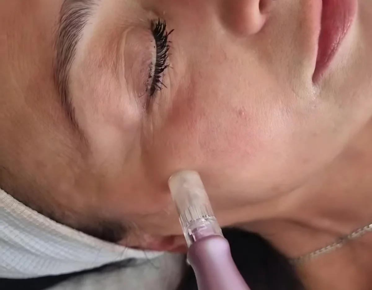 Mezo Glow – during treatment