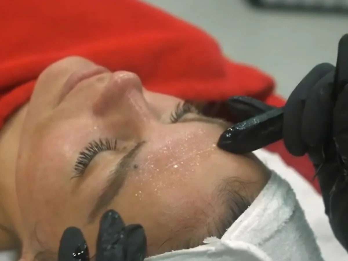 NanoLift – during treatment