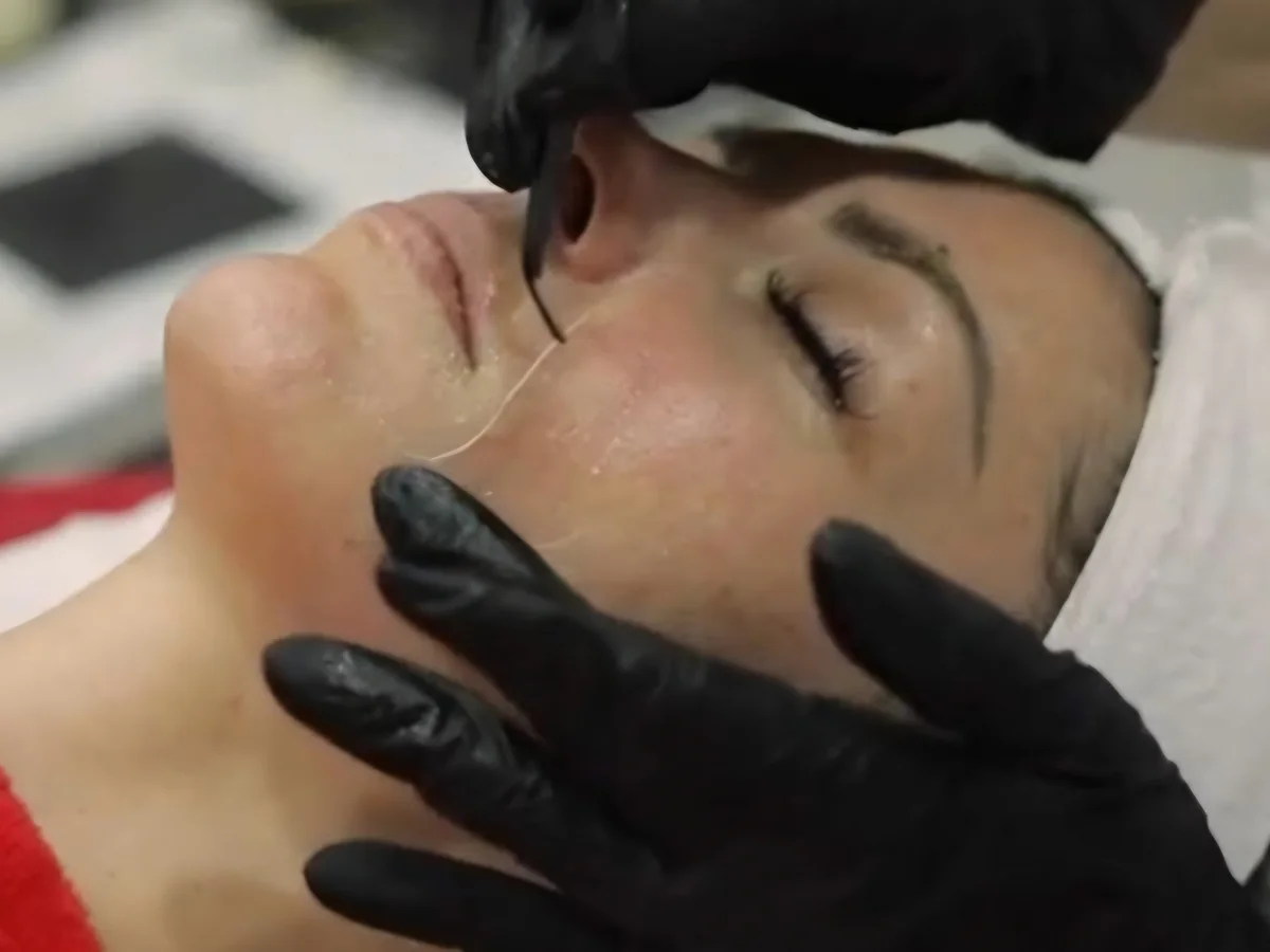 NanoLift – during treatment