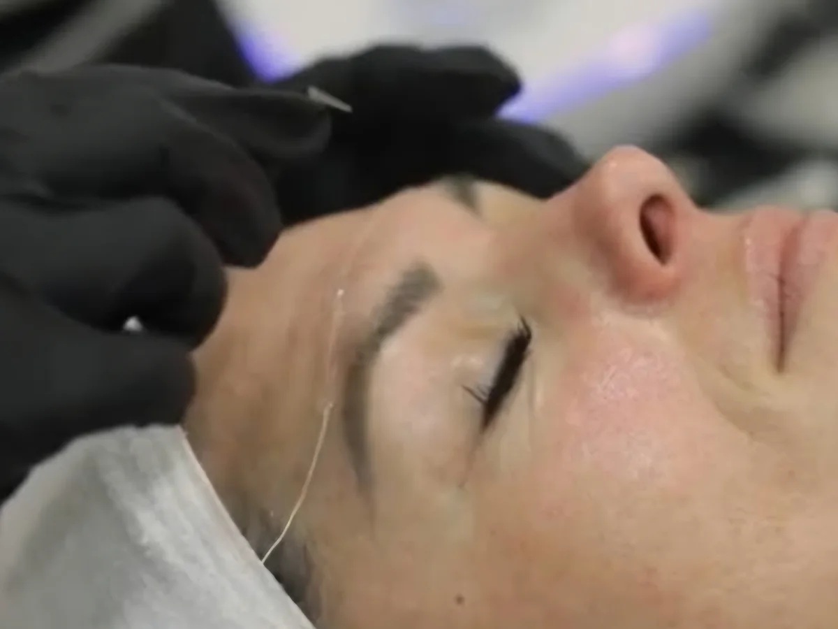 NanoLift – during treatment
