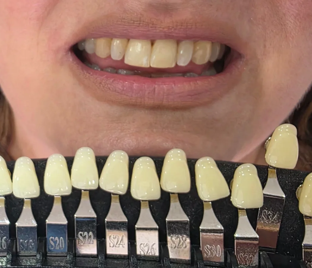 Sexy Smile – before