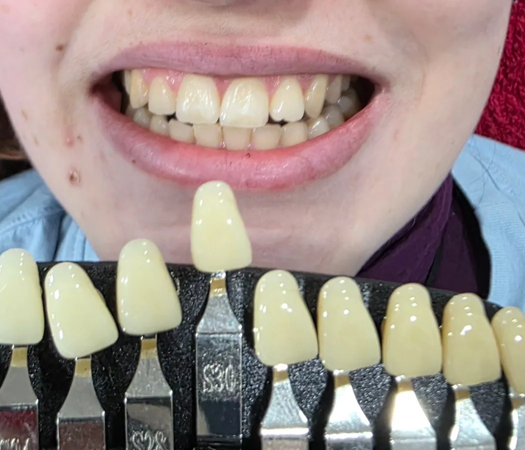 Sexy Smile – before