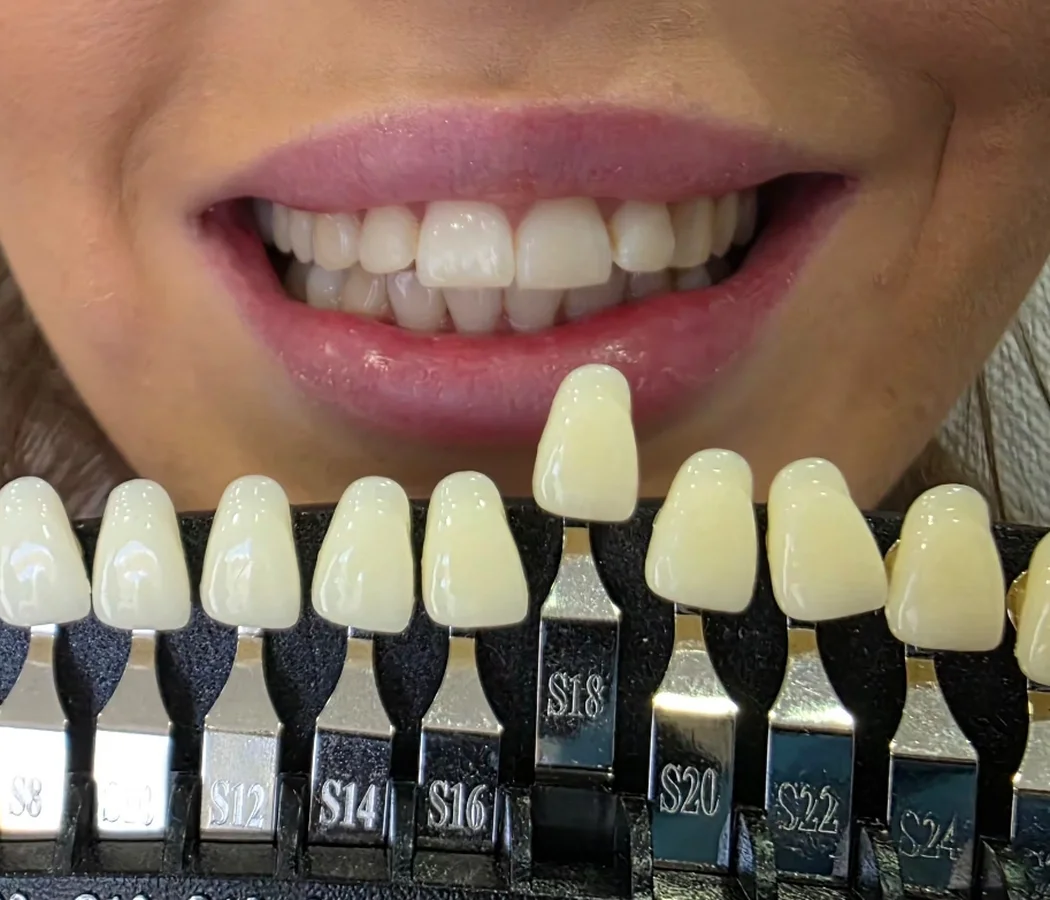 Sexy Smile – before