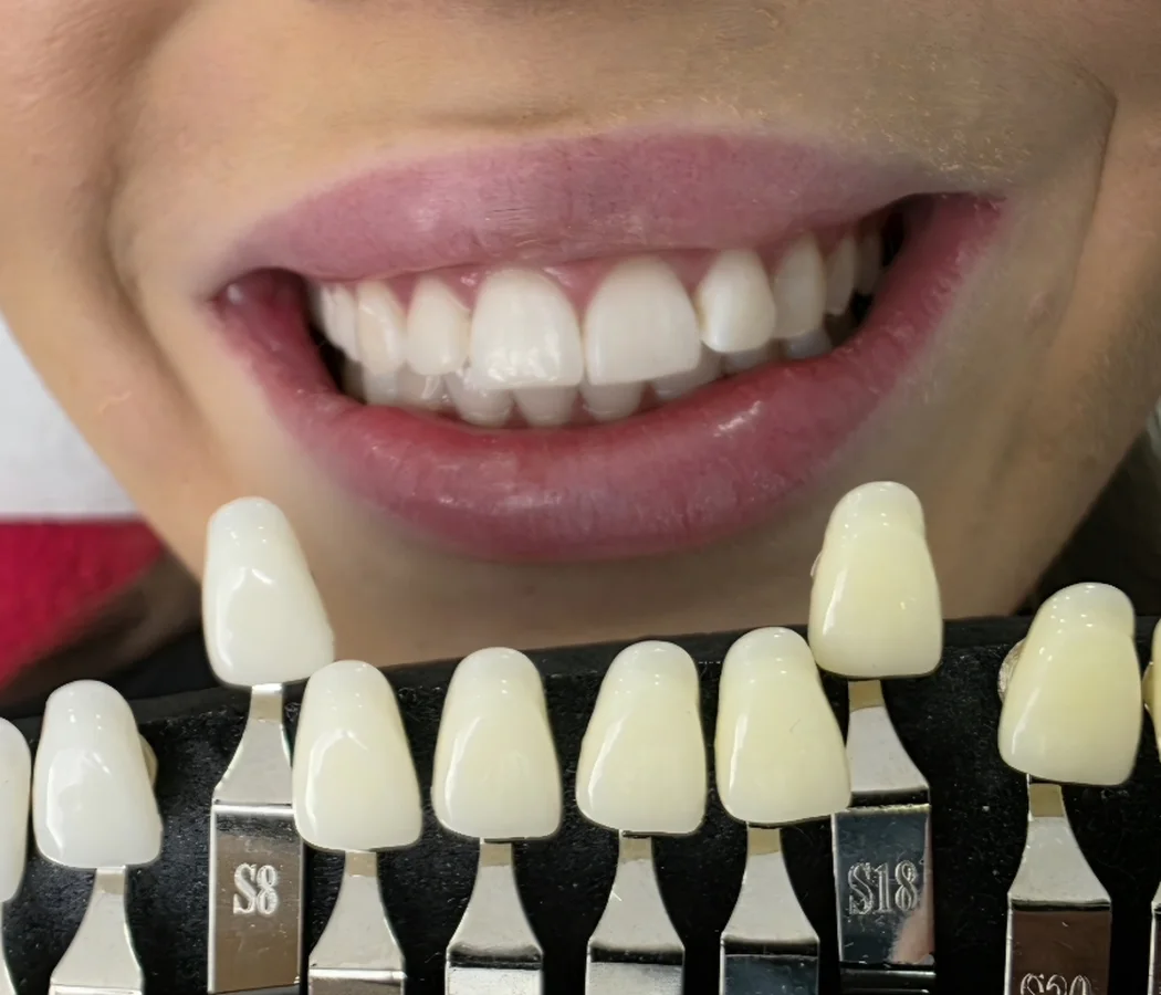 Sexy Smile – after